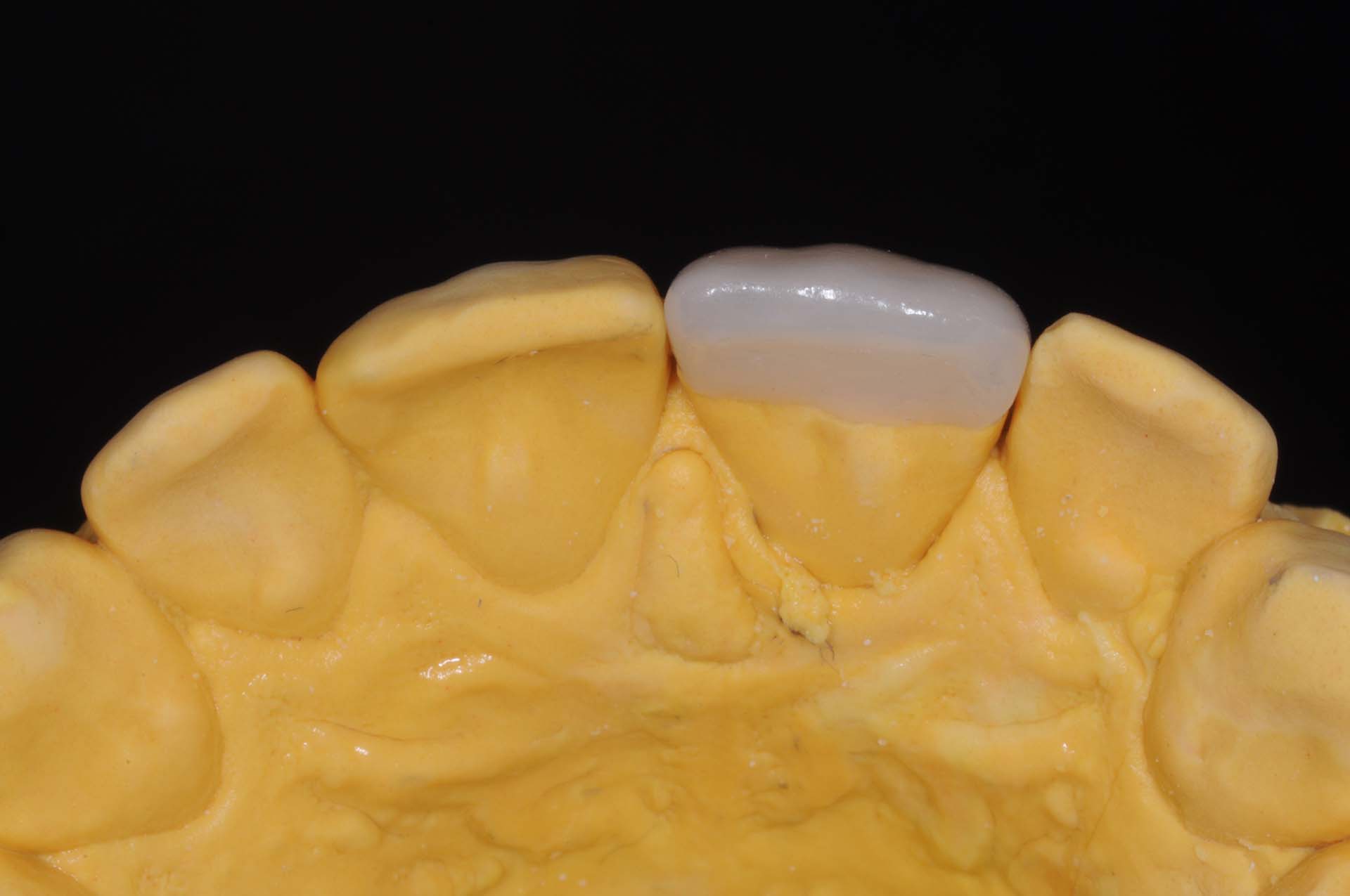 Veneer 21